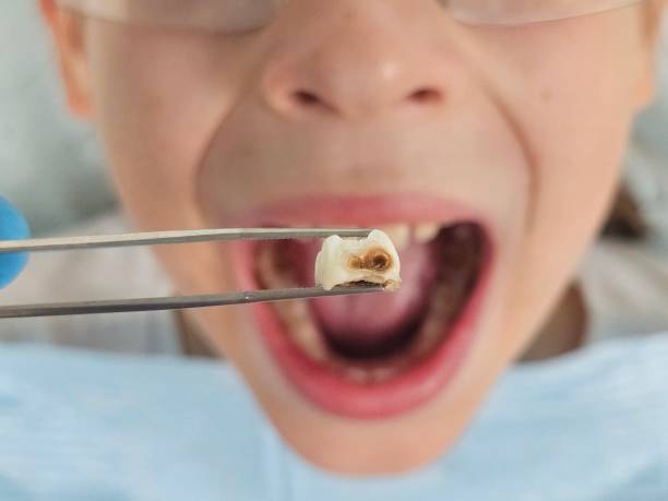 Best Emergency Wisdom Teeth Removal in Seven Corners, VA